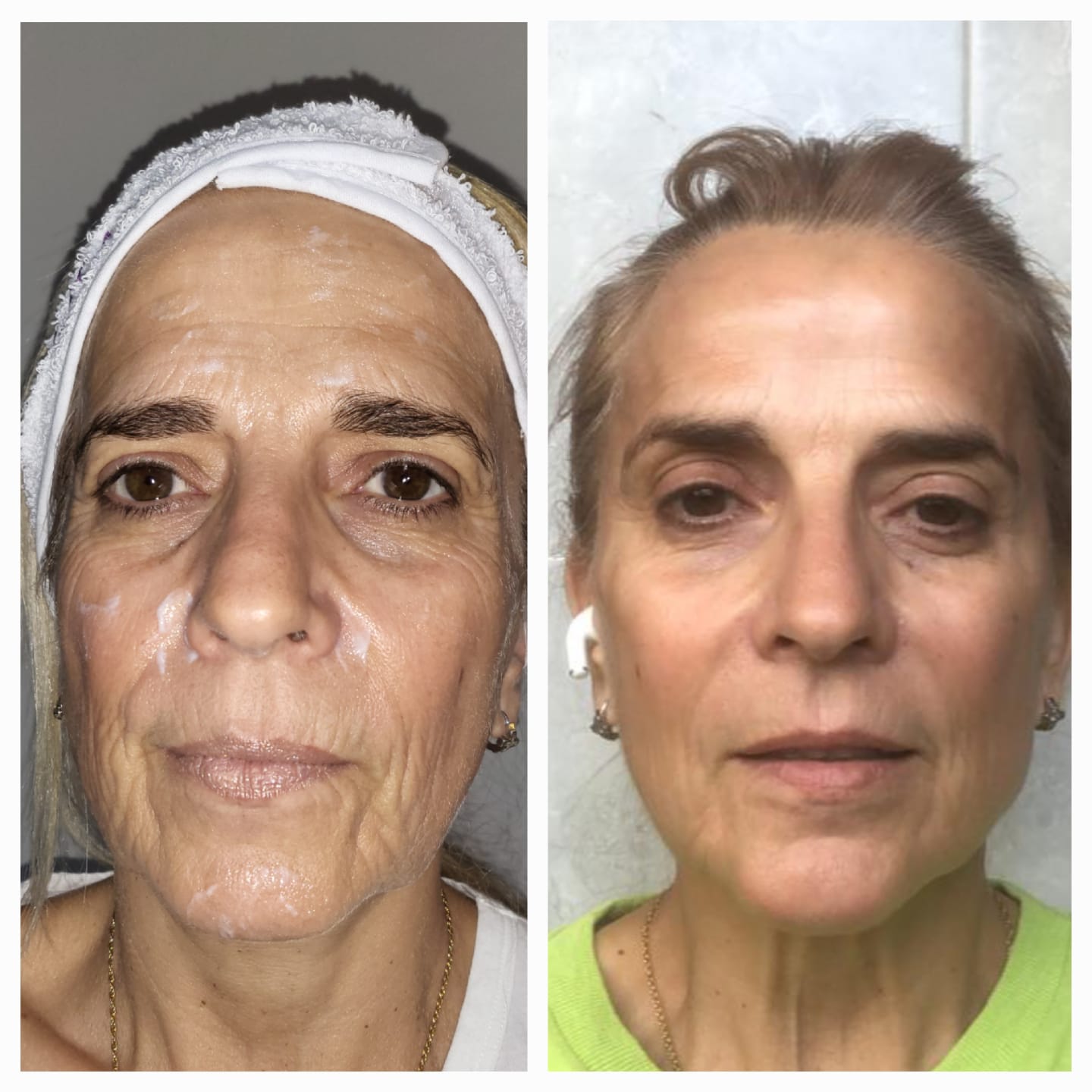 Antes y después de tratamiento facial